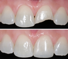 Restauração Odontológica