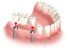 Implantes Dentais