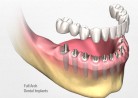 Implantes Dentais