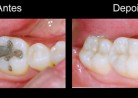 Restauração Odontológica